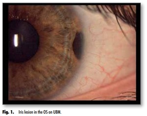 Figure from article: Iris melanoma in a...